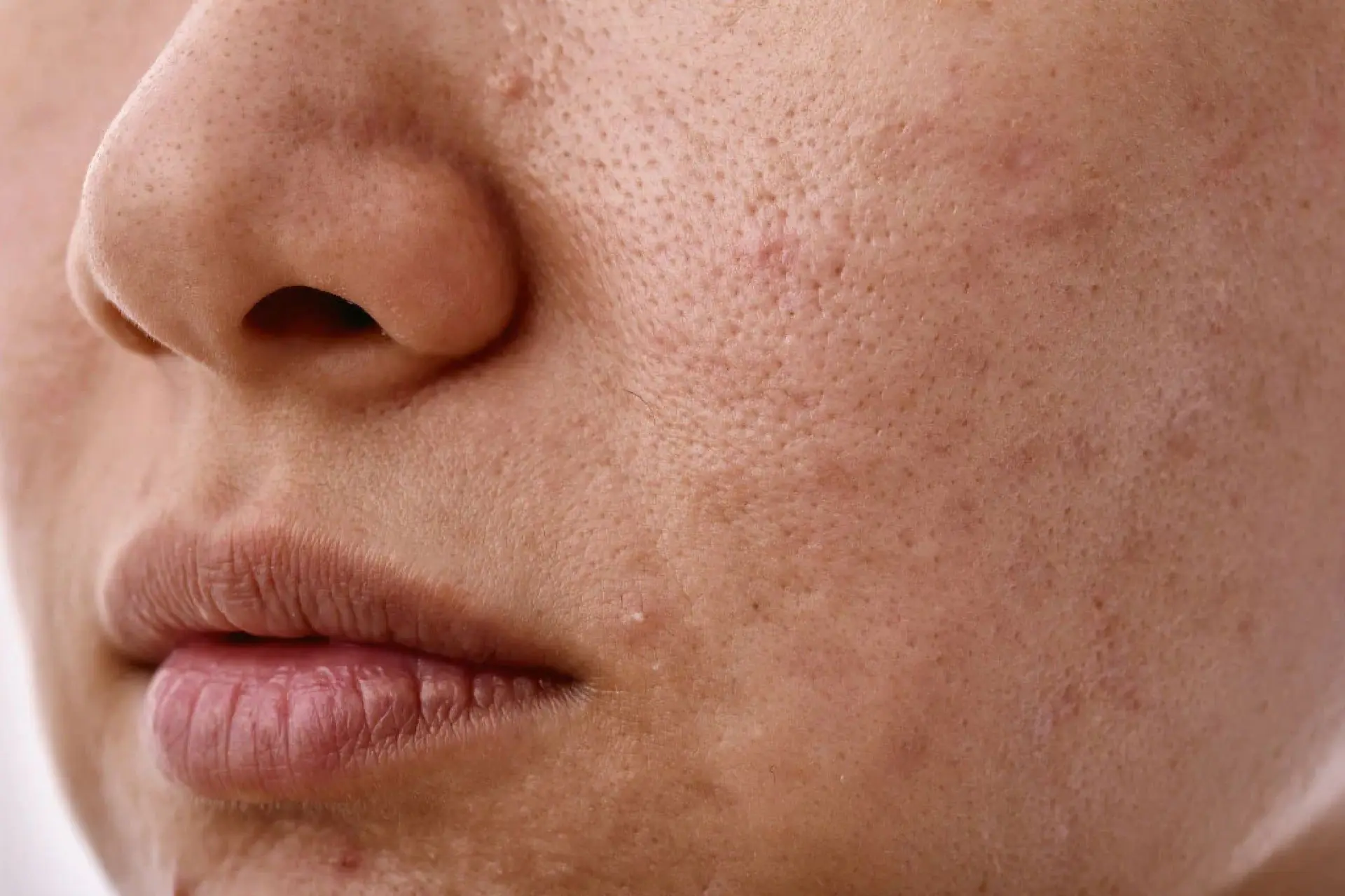 How Niacinamide Minimizes Pores & Controls Excess Oil Naturally – Foxtale